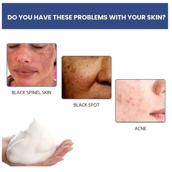 NWT Acne and Spots Cleansing Lotion Relief 50ml for Dry Skin Facial Cleanser - Picture 8 of 11